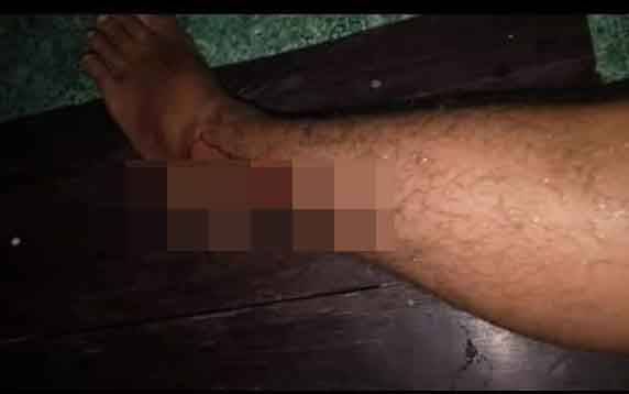 Luka di kaki korban keganasan buaya di Kecamatan Cempaga.