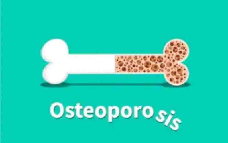 Ilustrasi osteoporosis. (foto : ANTARA/Shutterstock)