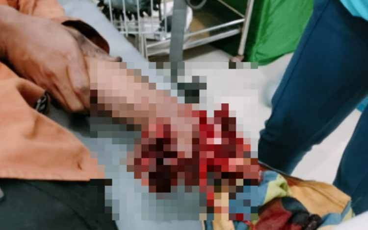 Tangan seorang pria di Kendari cedera parah akibat petasan rakitan saat merayakan malam Tahun Baru 2023, Minggu (1/1/2023). ANTARA/HO-Humas Polresta KendariKOMENTAR