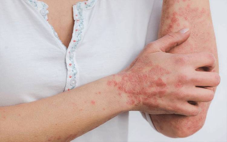 Ilustrasi psoriasis pada kulit. (ANTARA/Pixabay.com/Miller_Eszter)