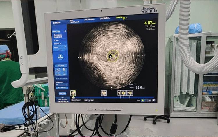 Alat monitor ultrasonografi intravaskuler atau Intra Vascular Ultrasound (IVUS). (FOTO: TRI)