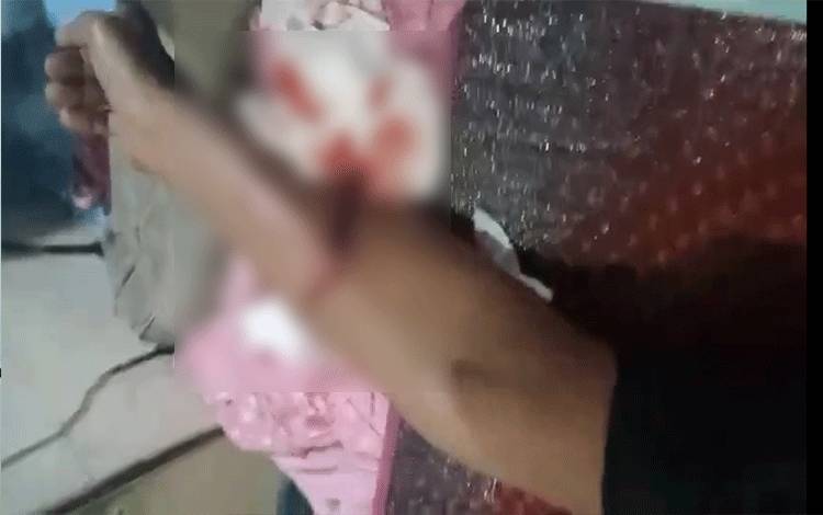 Tangkapan layar kondisi tangan korban terluka parah akibat diterkam buaya saat wudu di tapi Sungai Desa Tanjung Terantang. (Foto : ISTIMEWA)