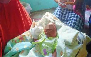 Bayi Berusia 2 Hari di Palangka Raya Bergelut dengan Tumor di Dahi