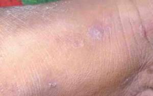 Sejumlah Warga di Kabupaten Kobar Tertular Penyakit Kulit Scabies
