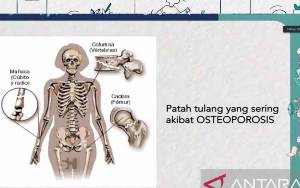 Cek Kesehatan Tulang Dini dan Asupan Gizi Bisa Cegah Osteoporosis
